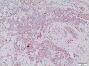 Brustkrebszellen in fettreichem Brustdrüsengewebe. Die braun gefärbten Zellwände zeigen das Vorhandensein der Stammzellmarker CD47 bzw. MET an. | © dkfz.de