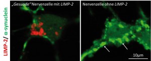 Bildunterschrift: Wenn LIMP-2 (rot angefärbt) in Nervenzellen vorhanden ist, sammelt sich nicht so viel α-Synuclein (grün angefärbt) an. Im Gegensatz dazu sammelt sich in einer Zelle, aus der LIMP-2 experimentell entfernt wurde, viel α-Synuclein an. © Biochemisches Institut, CAU
