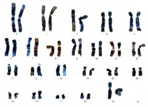 Chromosomensatz eines Mädchens. Jeder Mensch besitzt einen doppelten Chromosomensatz. In jedem seiner Gene können Mutationen auftreten. Dabei ist die Verteilung zwischen Mutationen die in cis, also im gleichen Gen auftreten und solchen die in den beiden verschiedenen Genvarianten auftreten ungleich verteilt. Es kommen deutlich mehr Mutationen in cis-Position vor, als in trans. Das Verhältnis ist dabei 60:40. In der cis-Konfiguration treten zwei Mutationen in ein und derselben Genkopie auf. Das zugehörige Protein wird dadurch außer Gefecht gesetzt. Die zweite Kopie und deren Protein bleiben aber unbehelligt. In der trans-Konfiguration sind dagegen beide Genkopien mutiert und produzieren zwei geschädigte Proteine. ©  CC BY-SA 3.0