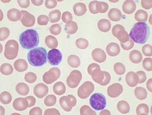 Blutausstrich einer CLL Patientin. Die Zellenmit dem dunklen Zellkern sind die CLL-Zellen © Mary Ann Thompson. CC BY-SA 3.0
