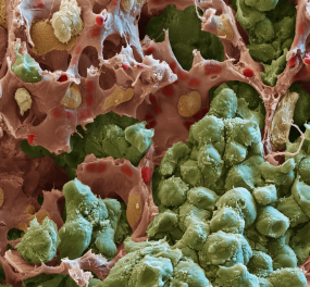 Rasterelektronenmikroskopische Aufnahme einer Lungenmetastase: Tumorzellen (grün) formen solide Tumorknoten, die in engem Kontakt mit umgebenden Kapillaren (rot) stehen. Die wechselseitige Kommunikation zwischen Tumorzellen und Endothelzellen ermöglicht das Wachstum von Metastasen. Endothelzellen können das Tumorwachstum dabei aktiv fördern. | © Oliver Meckes (Eye of Science) / H. Augustin (DKFZ)