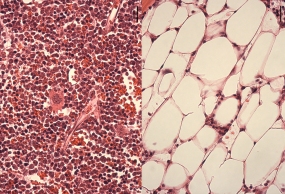Nach einer Behandlung, die schlafende Blutstammzellen aufweckt: Das Knochenmark normaler Mäuse (links) ist vollgepackt mit Blutzellen verschiedener Reifestadien. Bei einer Maus mit dem Fanconi-Defekt dagegen führt diese Behandlung zum „Knochenmarksversagen“, anstelle der Blutzellen haben sich Fettzellen angesiedelt. © Michael Milsom, DKFZ
