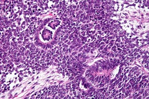 Wilms-Tumor  (Nephroblastom). © Nephron. CC BY-SA 3.0. 