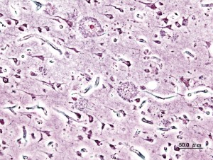 Alzheimer Palques bestehen aus Proteinaggregaten von Beta-Amyloid- (Aβ)-Peptiden. Sie werden oft auch als Plaques bezeichnet. © KGH. Wikimedia Commons. CC BY-SA 3.0