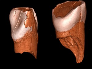 Dreidimensionale digitale Modelle des unteren Schneidezahns aus Riparo Bombrini (links) und des oberen Schneidezahns aus der Grotta di Fumane (rechts). Bei beiden Zähnen handelt es sich um Milchzähne. © Daniele Panetta