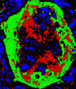 Gefäß (grün) innerhalb eines ATLOs, das Immunzellen erlaubt, die Arterienwand zu infiltrieren (High Endothelial Venule, abgekürzt HEV). Die Entzündungsreaktion wird durch die rote Farbe angedeutet. DNA unterschiedlicher Zellen erscheint blau gefärbt.  © S.Mohanta, IPEK 