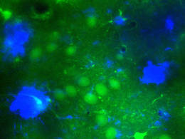 Mikroskopischer Einblick ins Alzheimer-Gehirn mit grün fluoreszierenden Nervenzellen in der Nähe der typischen Amyloid-Plaques (in blau dargestellt). © M. A. Busche / TUM