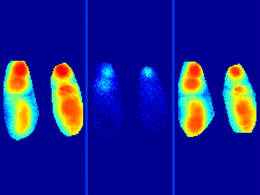 Darstellung von langsamen Wellen im Gehirn, die sich während des Schlafes normal ausbreiten (links). Durch die Amyloid-β-Plaques wird dieser Prozess massiv gestört (Mitte). Diese Störung wird durch die Gabe eines Benzodiazepins behoben (rechts). © Marc Aurel Busche / TUM