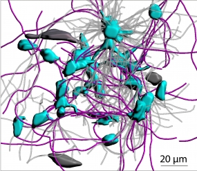 3D-Darstellung eines Glioblastoms: Vernetzte Krebszellen (blau) sind über lange Membranfortsätze (pink) miteinander verbunden. Unvernetzte Tumorzellen sind dunkelgrau, Membranfortsätze, die keine Zellen verbinden, hellgrau dargestellt. © Nature